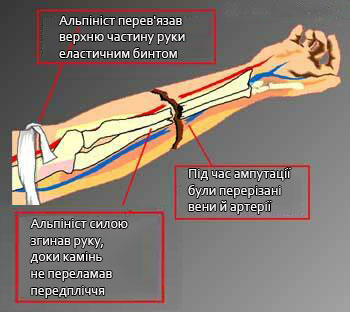 Ампутація... Коли постає питання жити чи померти - жити!